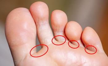 足の指の画像
